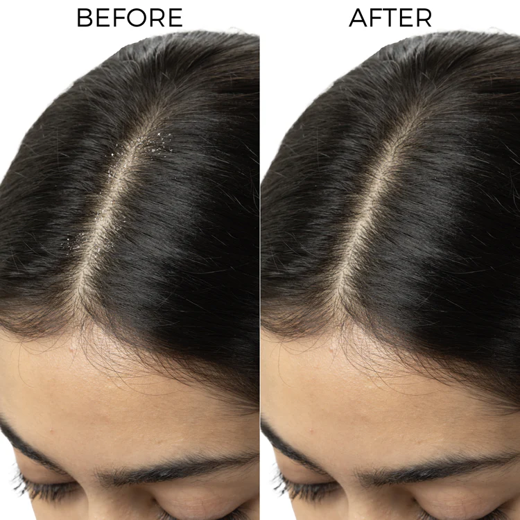 Tea Tree & Salicylic Oil Shots For Dandruff Control - Image 4